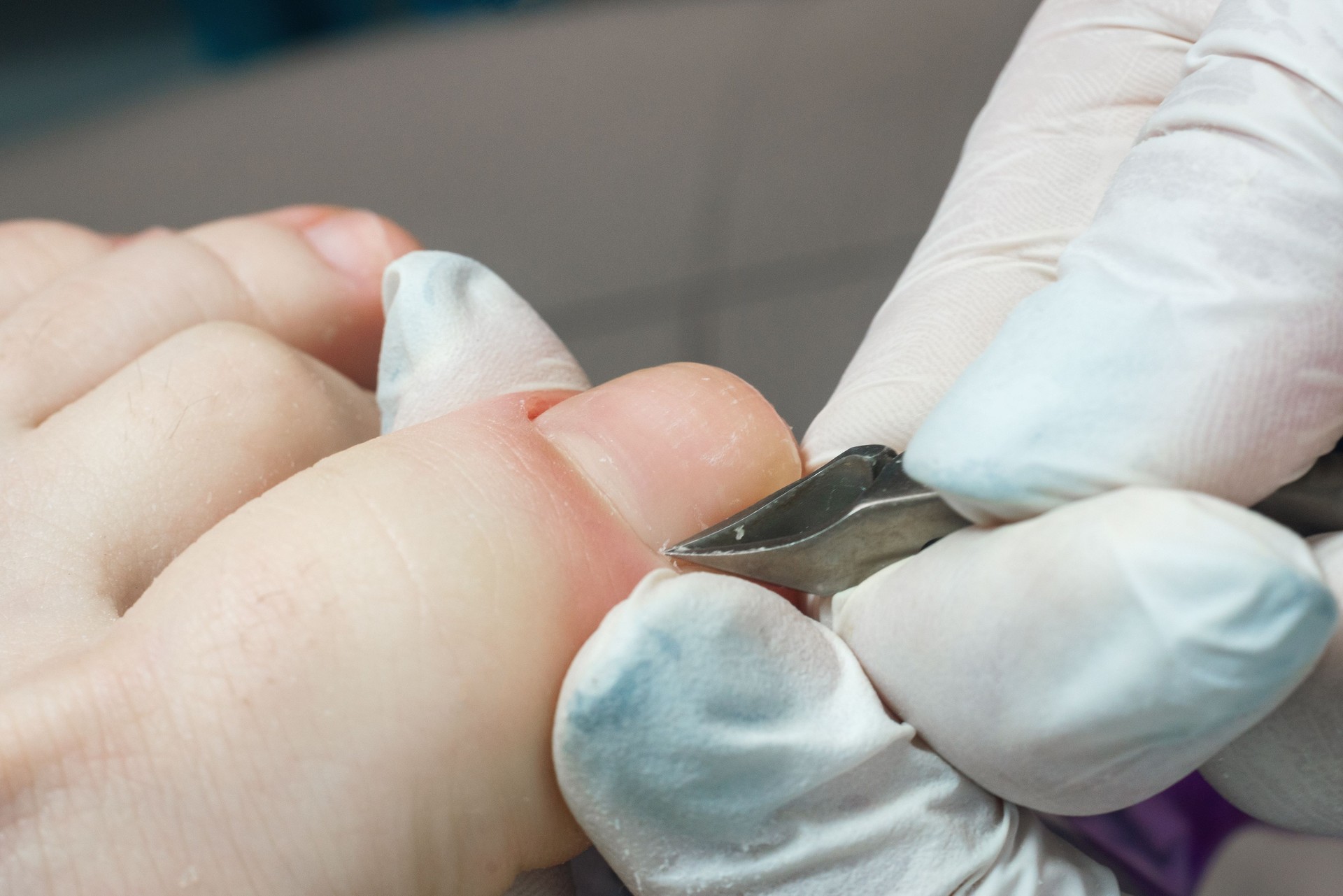 Podiatrist using pedicure clippers trims dry skin around a toenail