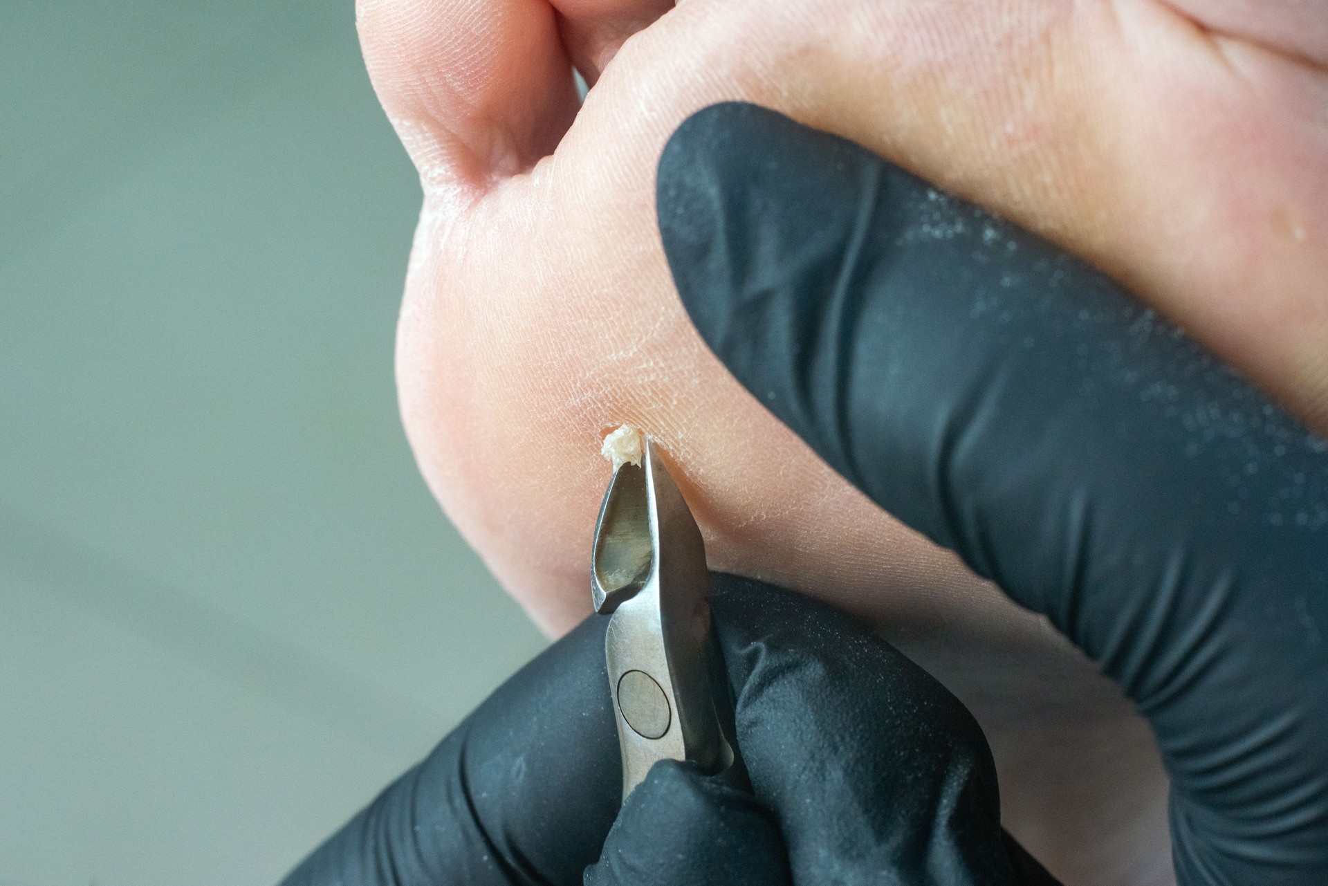 A podiatrist removes a callus on a woman's foot using pedicure nippers