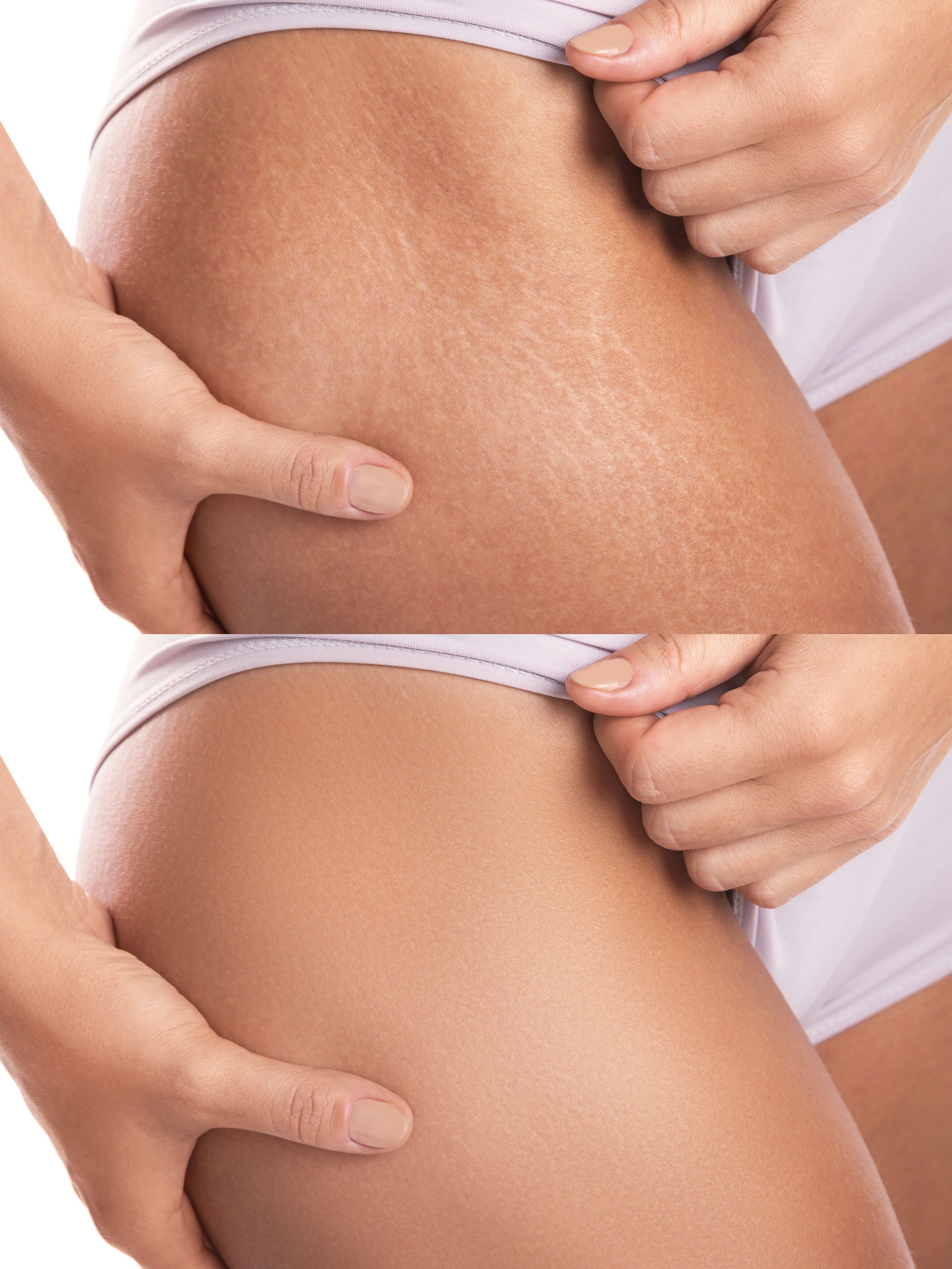 Hip after stretch mark removal treatment