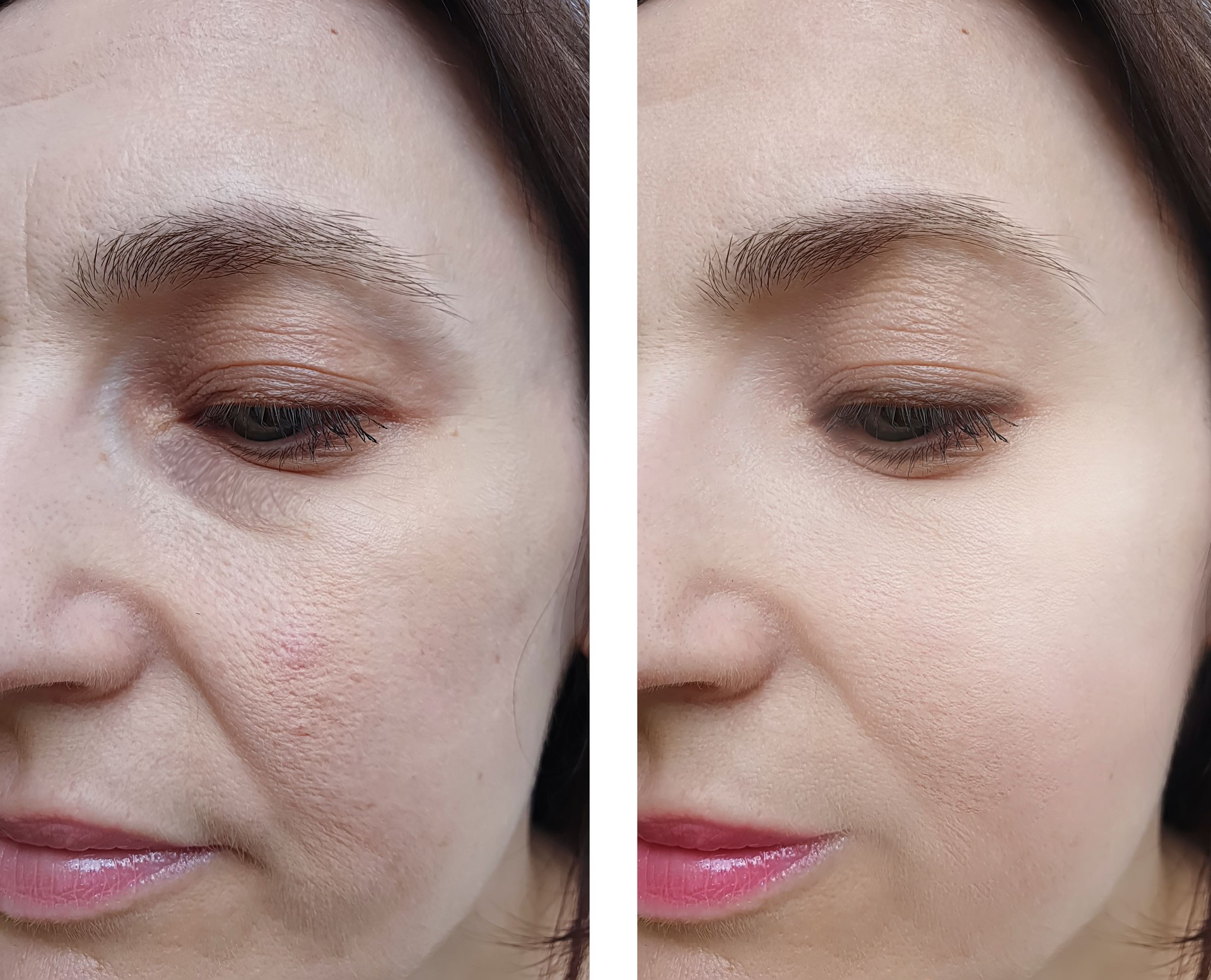 woman face wrinkles before and after treatment