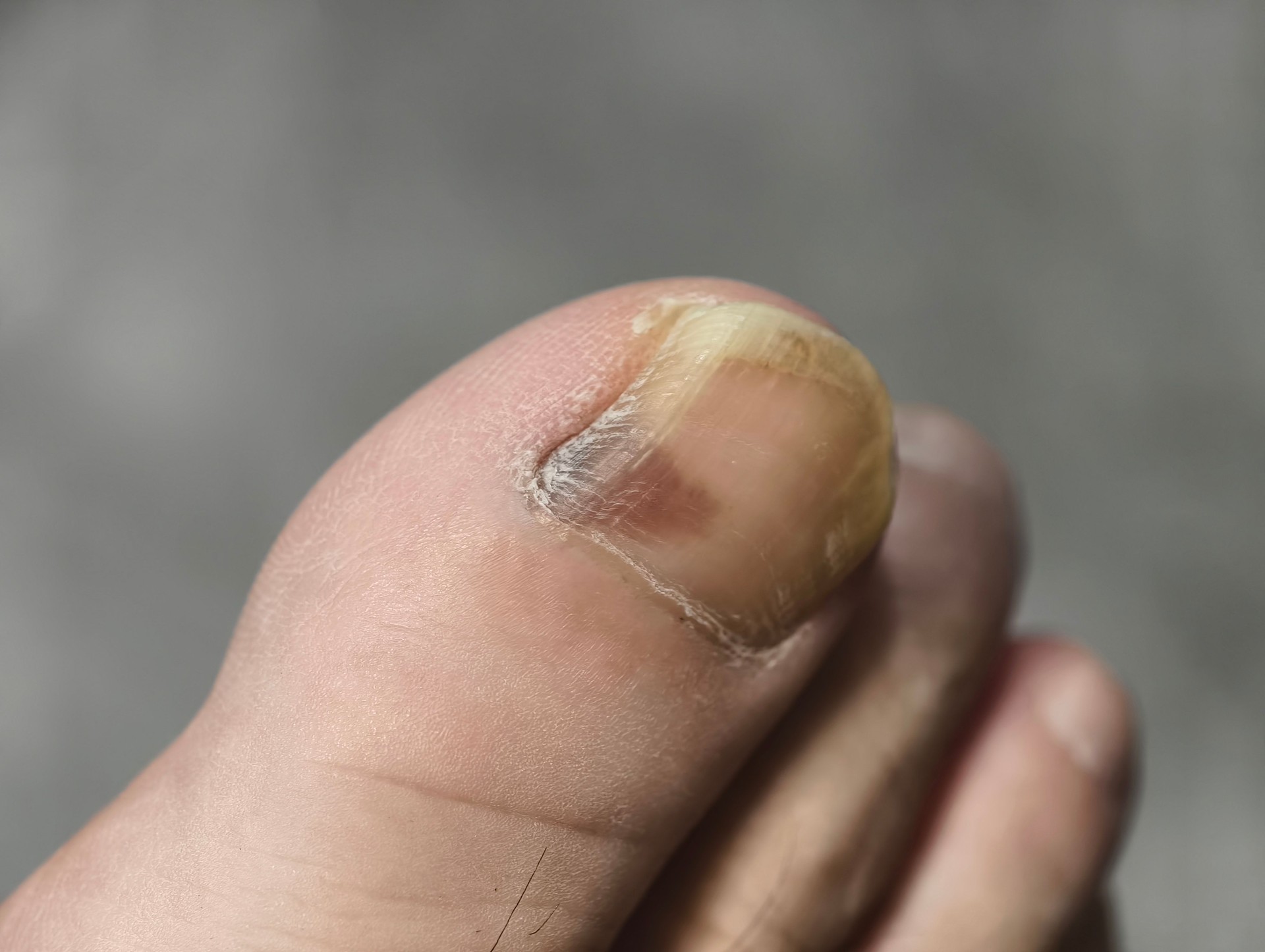 Fungal disease of the man's toenail