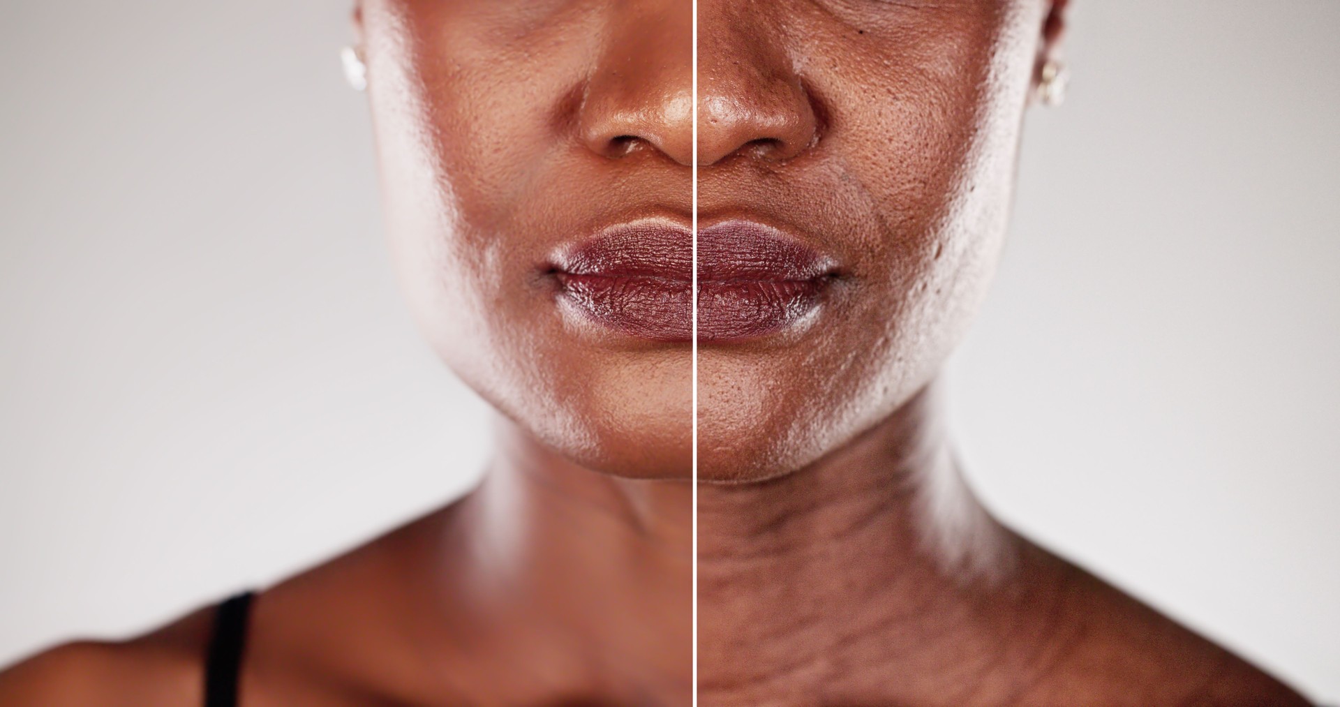 Transformation of a black woman's skin before and after a microdermabrasion facial treatment, showcasing the power