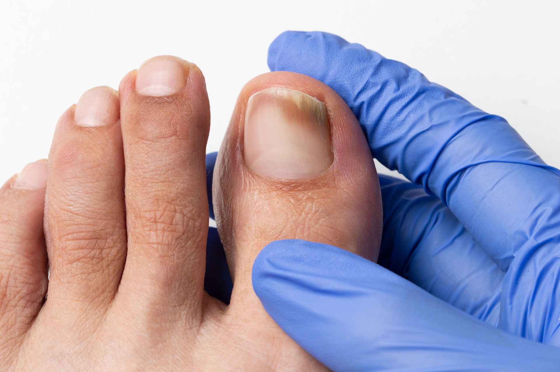 checking the damaged toenail